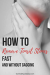how to remove tonsil stones without gagging