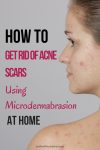 get rid of acne scars microdermabrasion