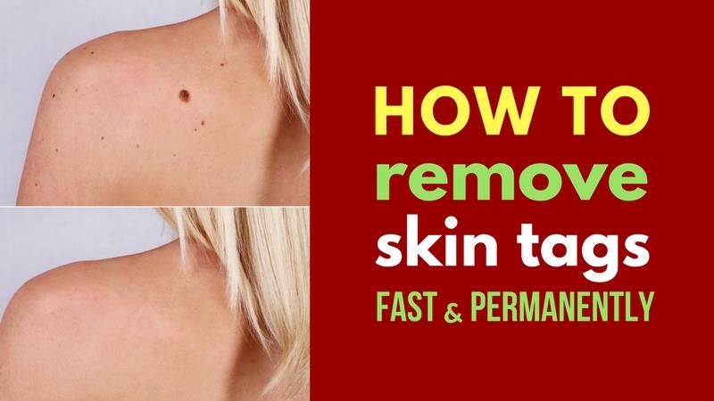 how to remove skin tags at home fast